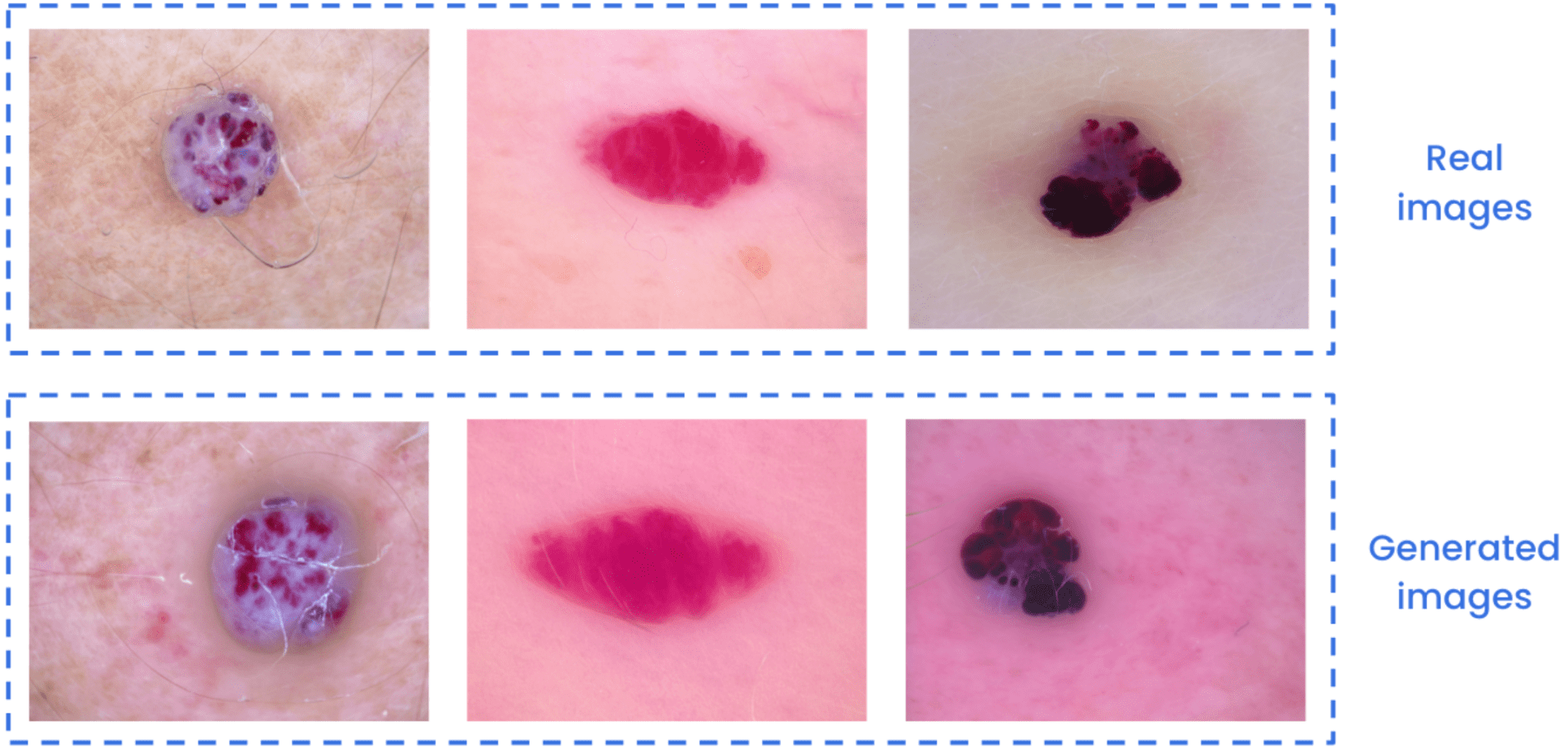 Vascular skin lesion generation with Diffusion